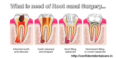 http://confidentdentalcare.in/php/root-canal-treatment-rct.php
