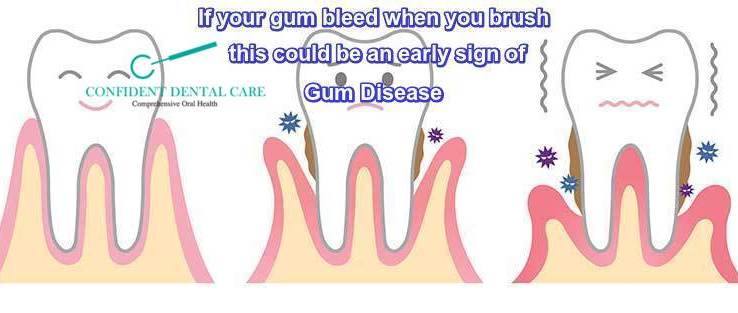 gum-disease-treatment-clinic-bangalore